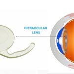 Eyeball Lens video camera implant, viewed illegally by Gurugram District Court Magistrates and Staff, and Gurugram Police Department