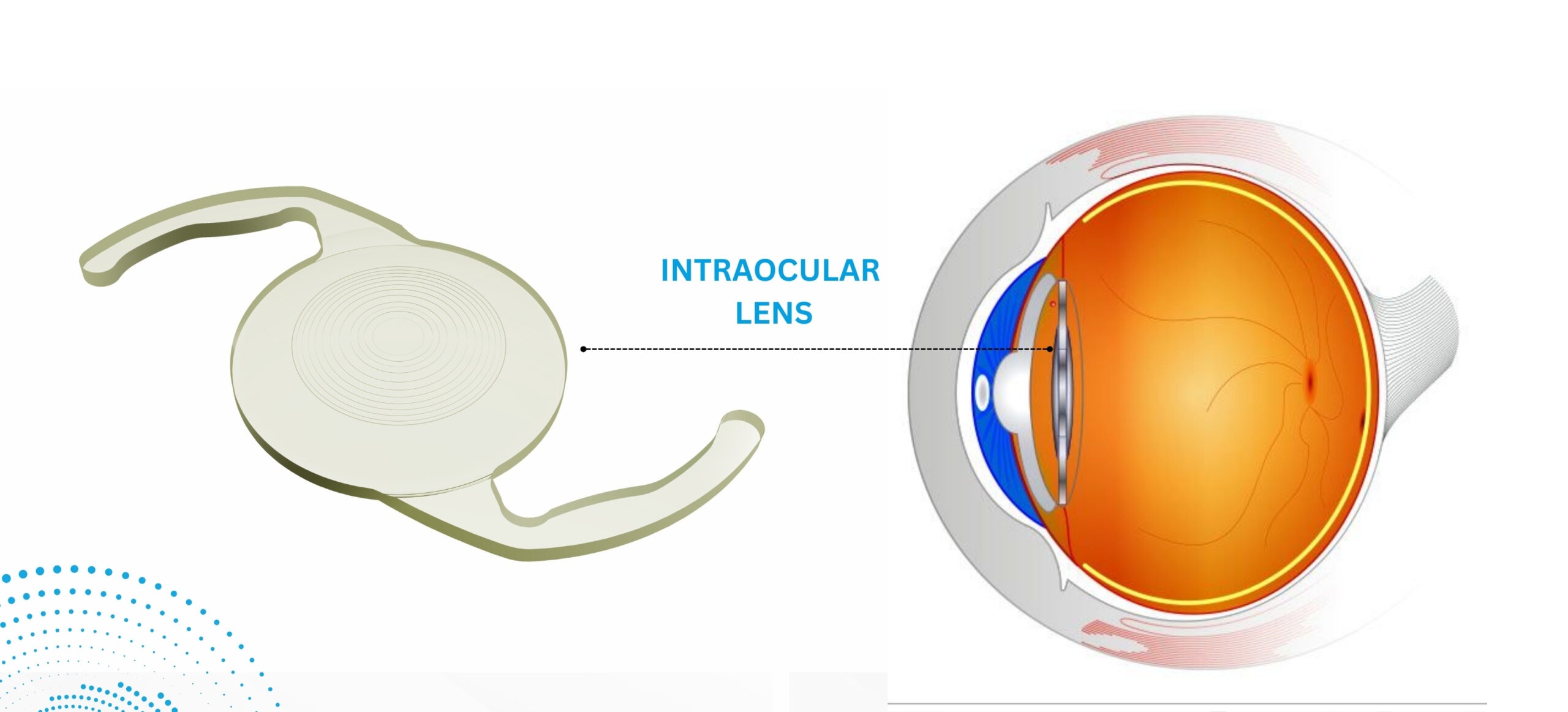 Eyeball Lens video camera implant, viewed illegally by Gurugram District Court Magistrates and Staff, and Gurugram Police Department