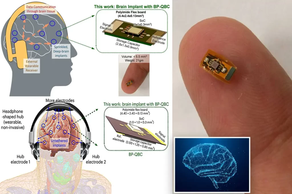 Brain implant